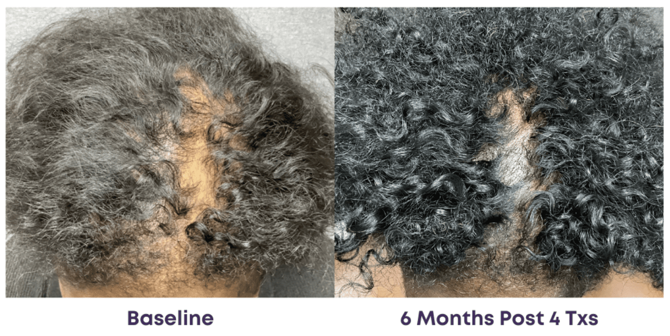 Hair growth comparison over six months after 4 treatments.