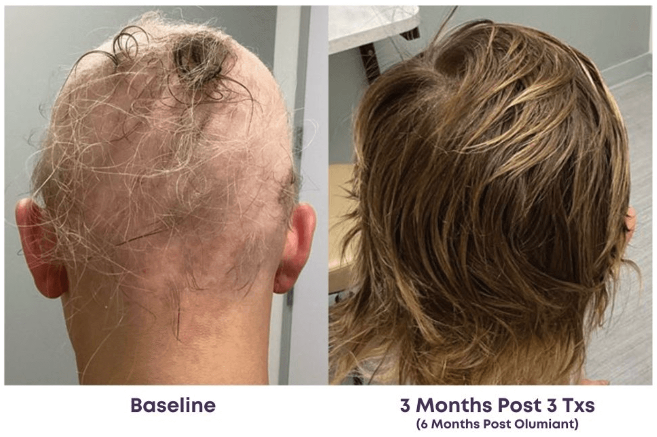 Hair growth comparison before and after treatment over 3 months and 3 treatments.