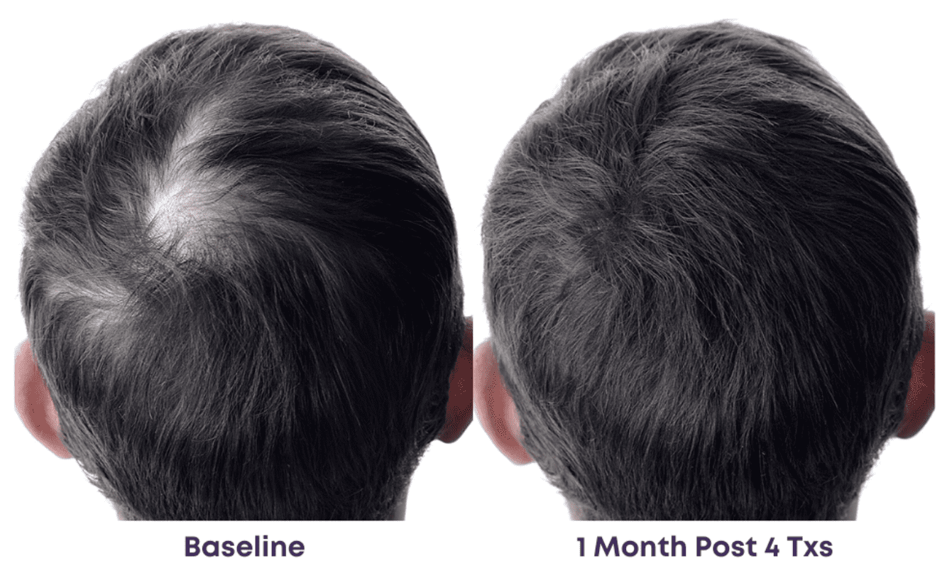 Hair growth comparison, baseline vs. one month.
