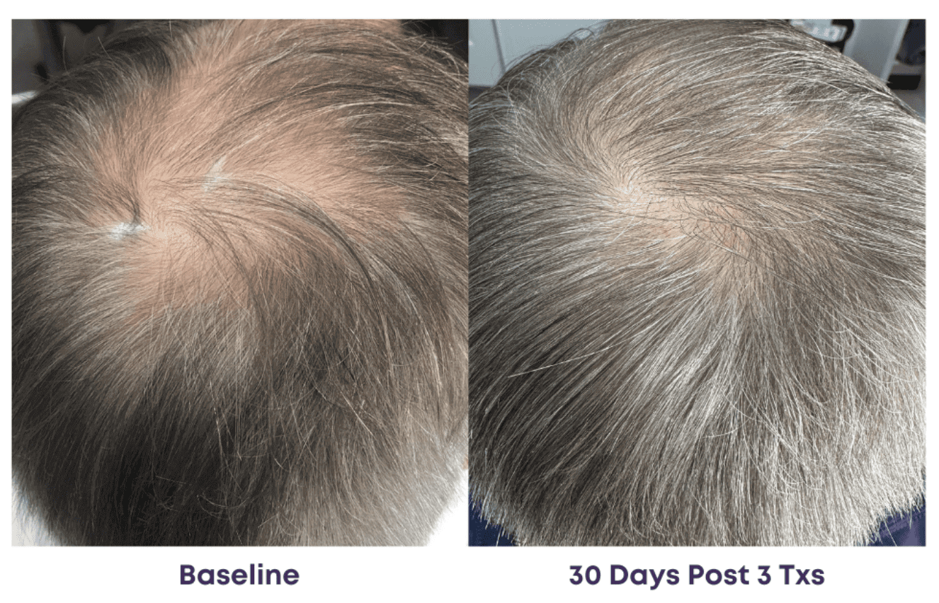 Hair growth comparison before and after treatment over 30 days.
