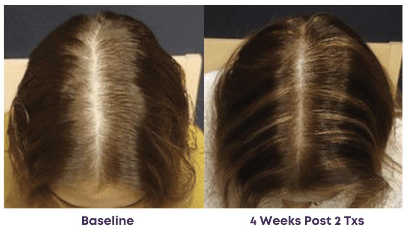 Before and after hair treatment comparison over 4 weeks.