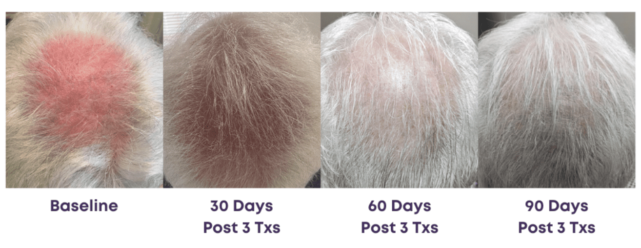 Hair restoration progression over 90 days.