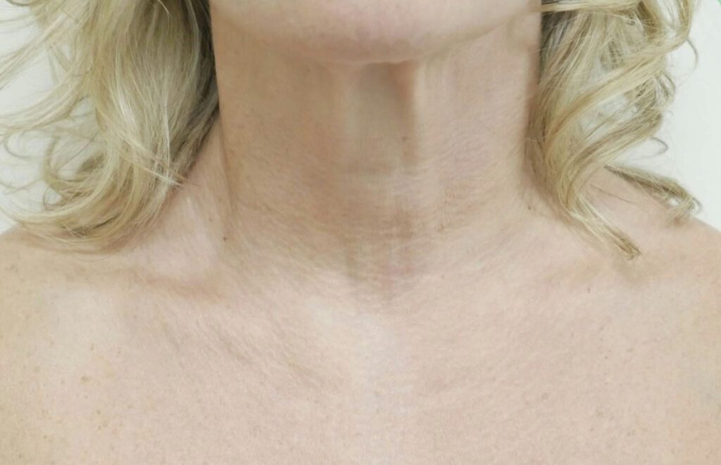 After photo for neck skin smoothing via microneedling for saggy skin reduction.