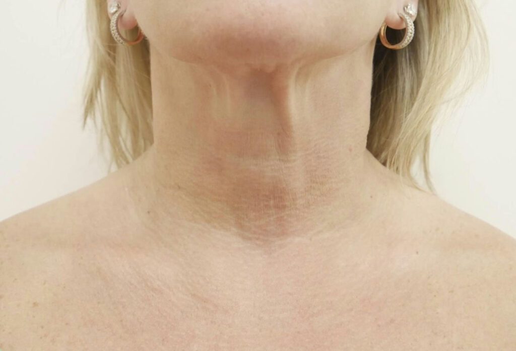 Before photo for neck skin area.