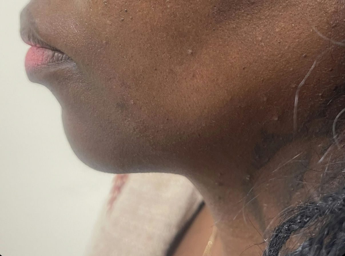 Before photo of chin.