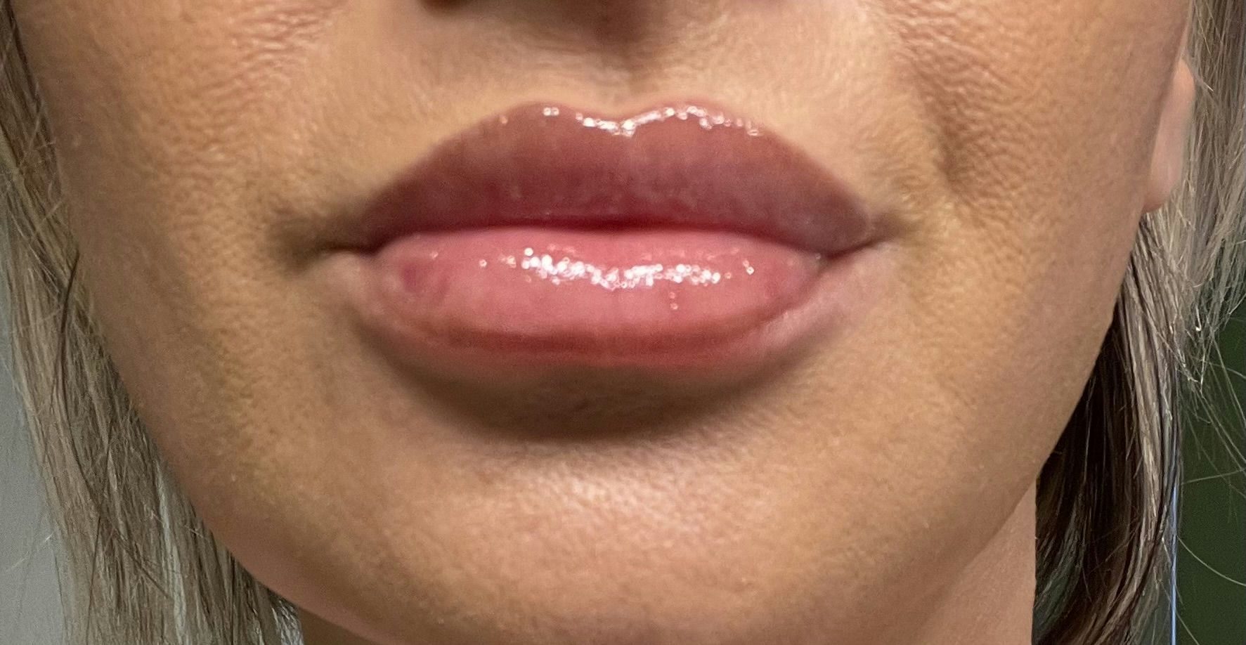 After photo of lip filler