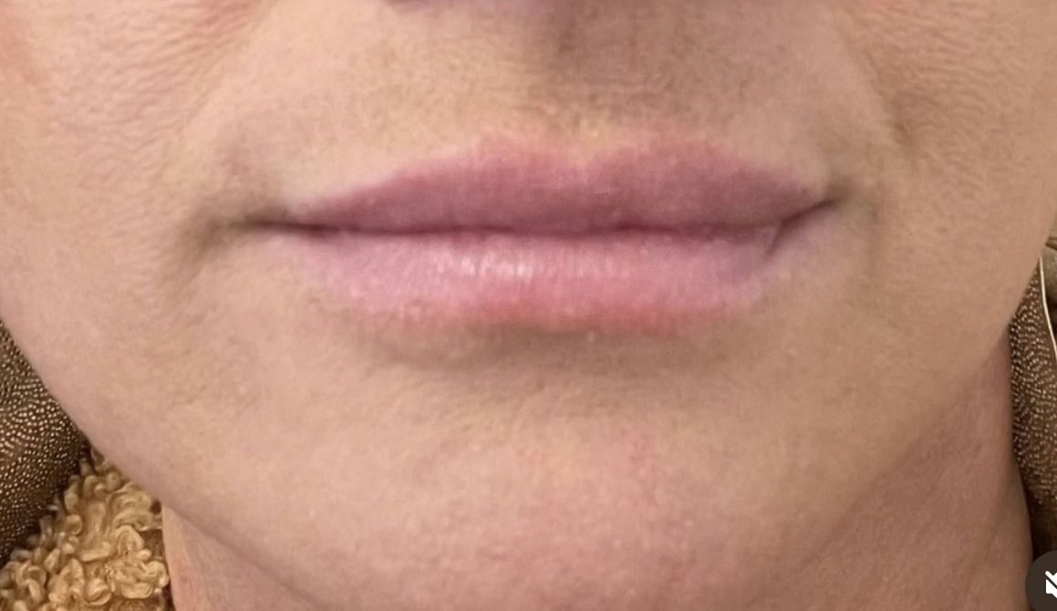 Before photo of lips.