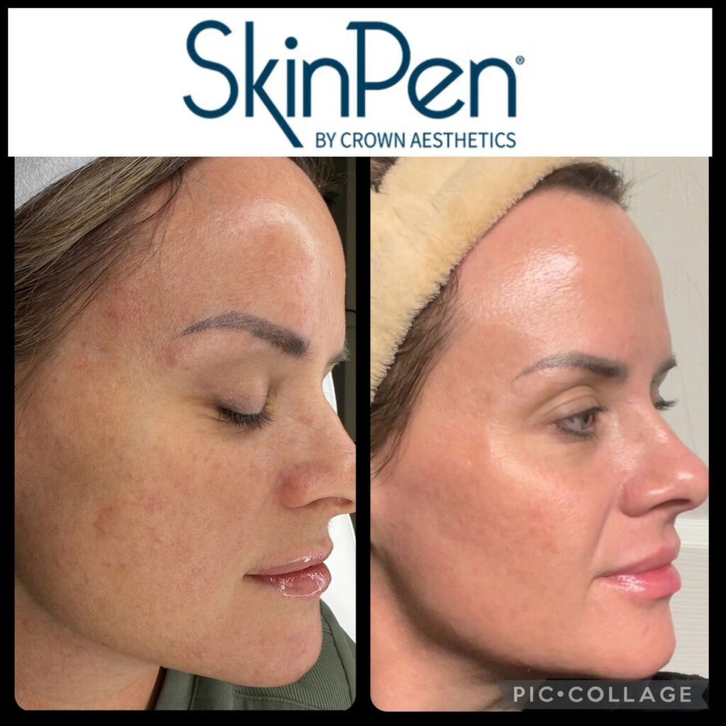 Before and after facial skin smoothing via microneedling, full side photo of face with clearer skin.
