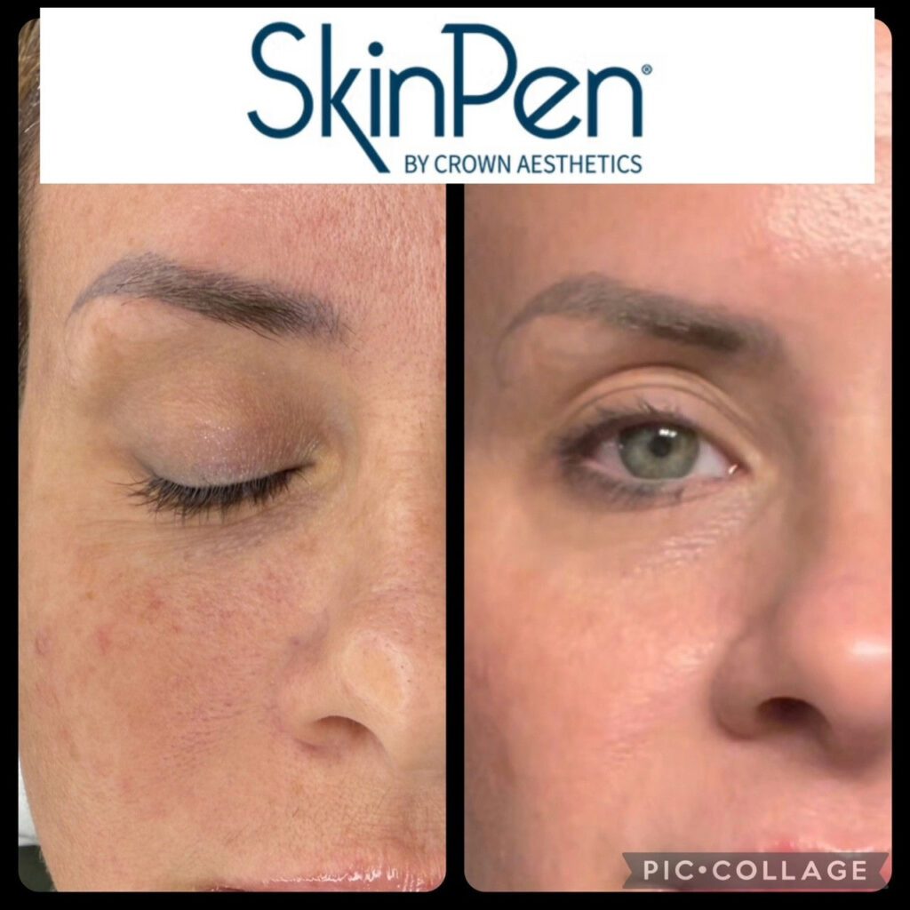 Before and after facial skin smoothing via microneedling around eye area with clearer skin.