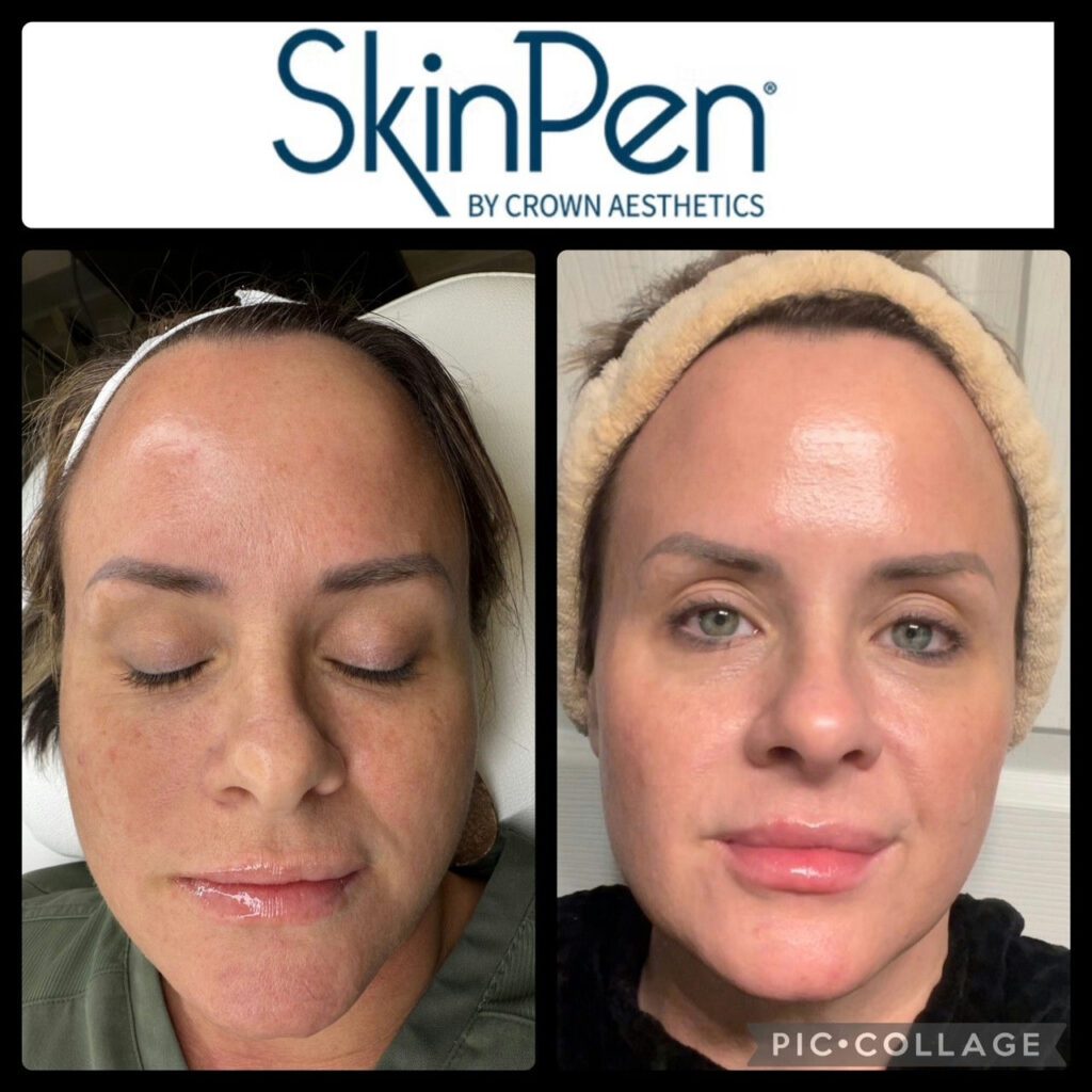 Before and after facial skin smoothing via microneedling, full front photo of face with clearer skin.