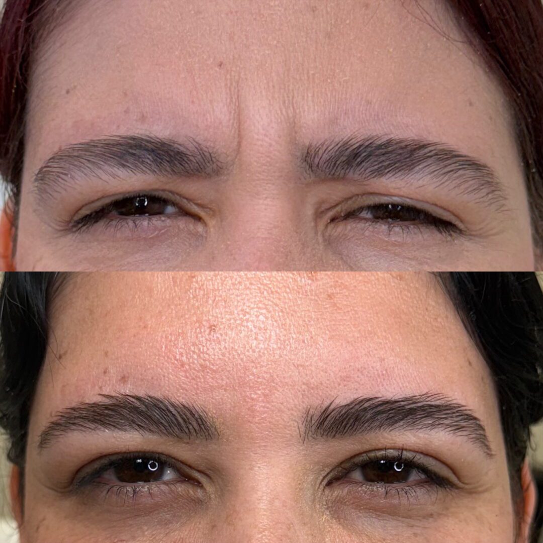 Before and after, forehead botox.