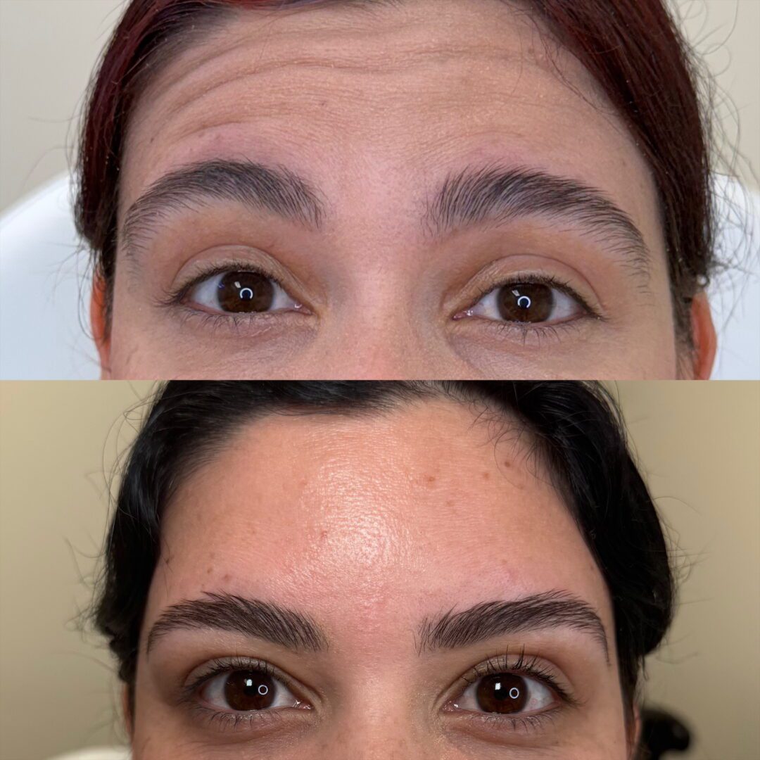 Before and after, forehead botox.