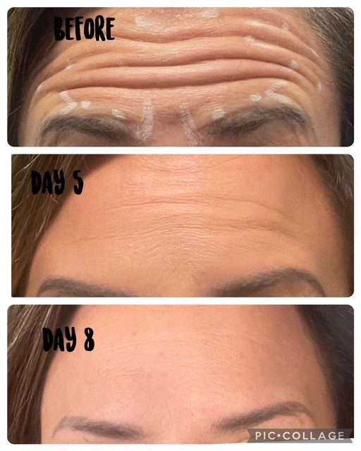 Before and after, forehead botox over 8 days.