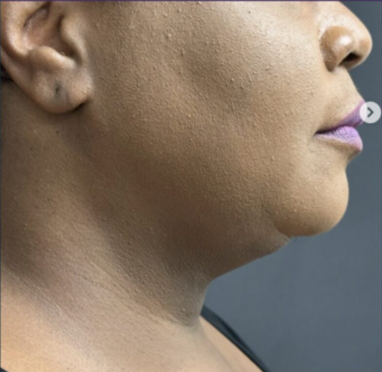 After neck and double chin liposuction