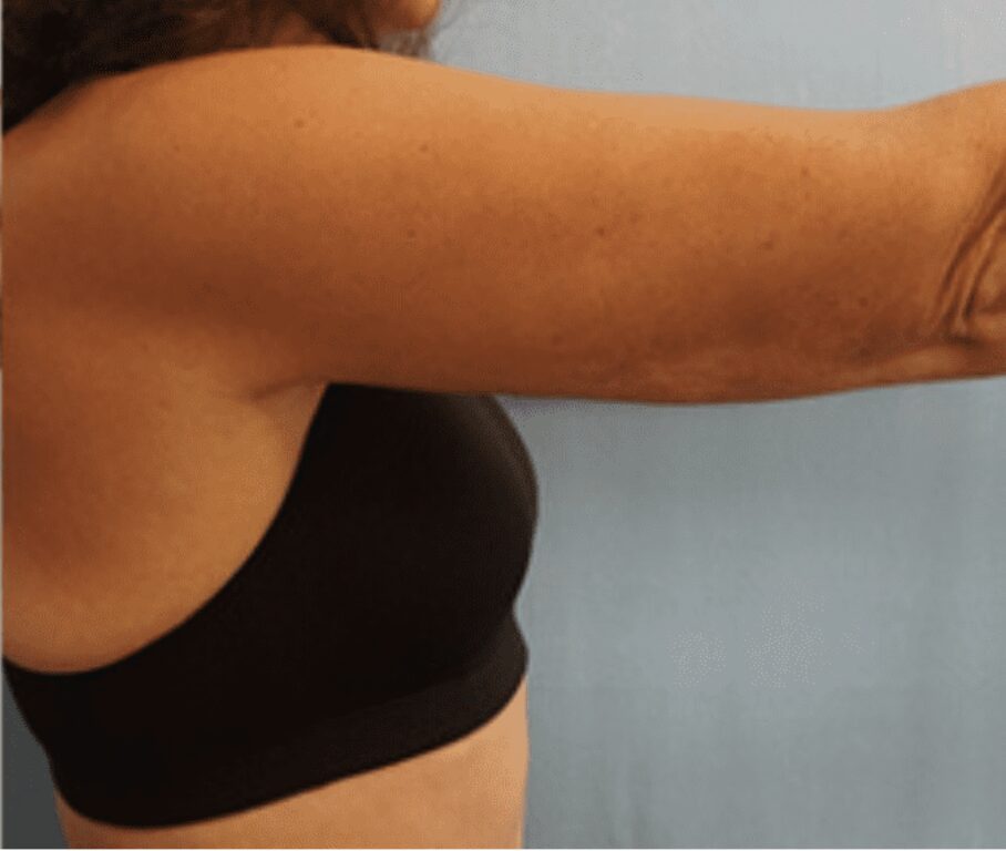 After arm liposuction
