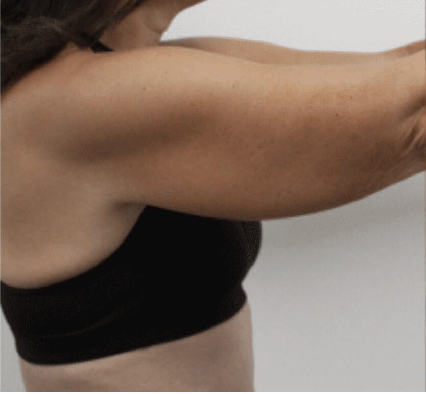 Before arm liposuction