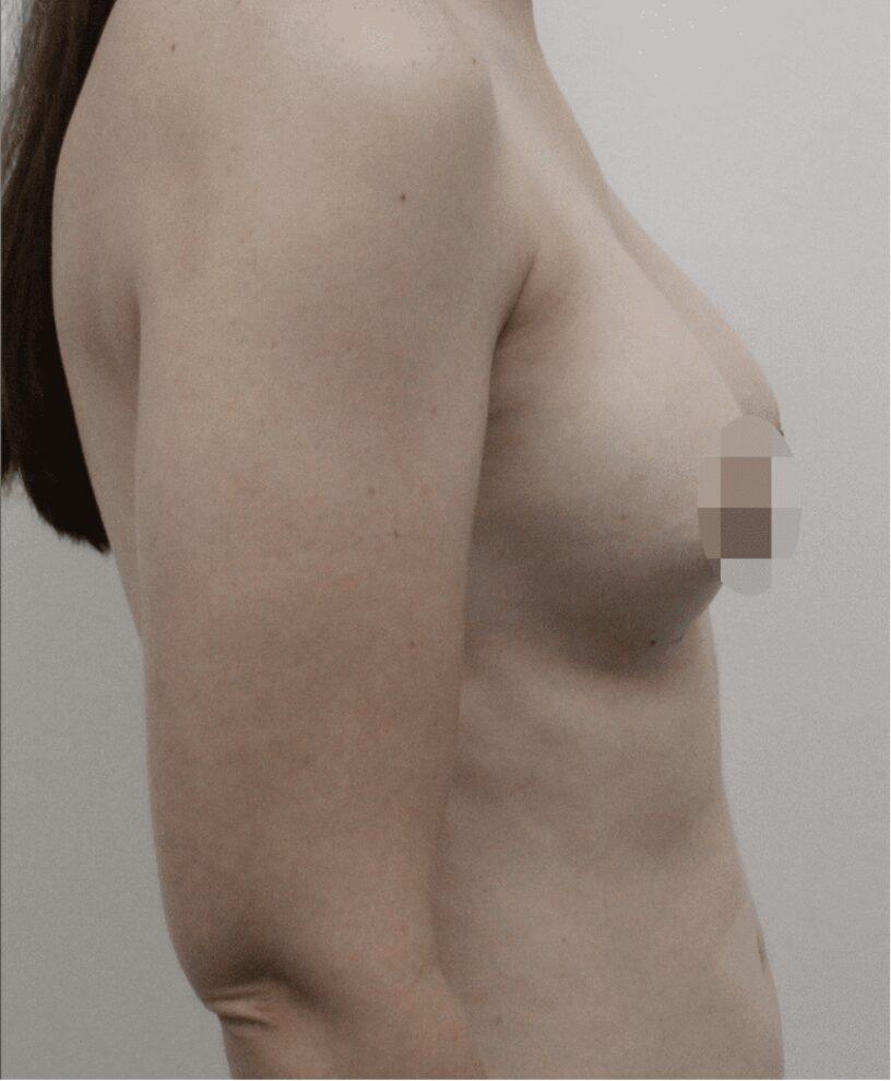 After breast augmentation, side view