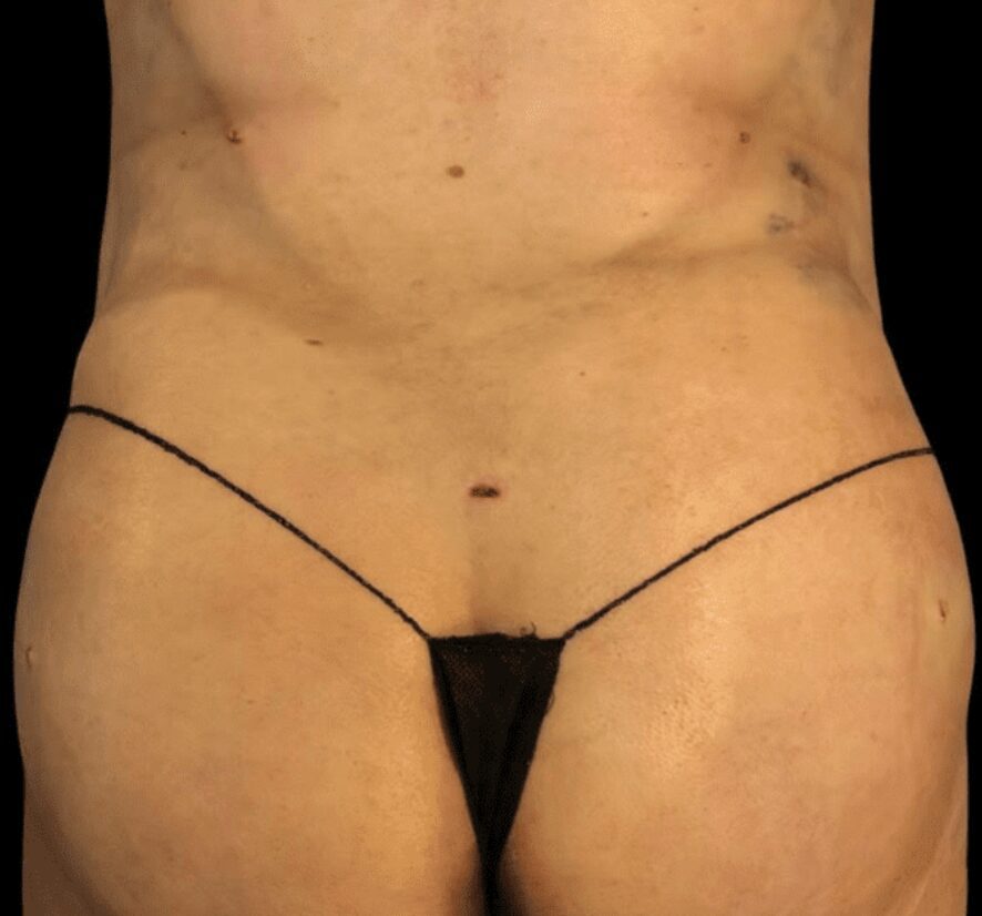 After stomach liposuction