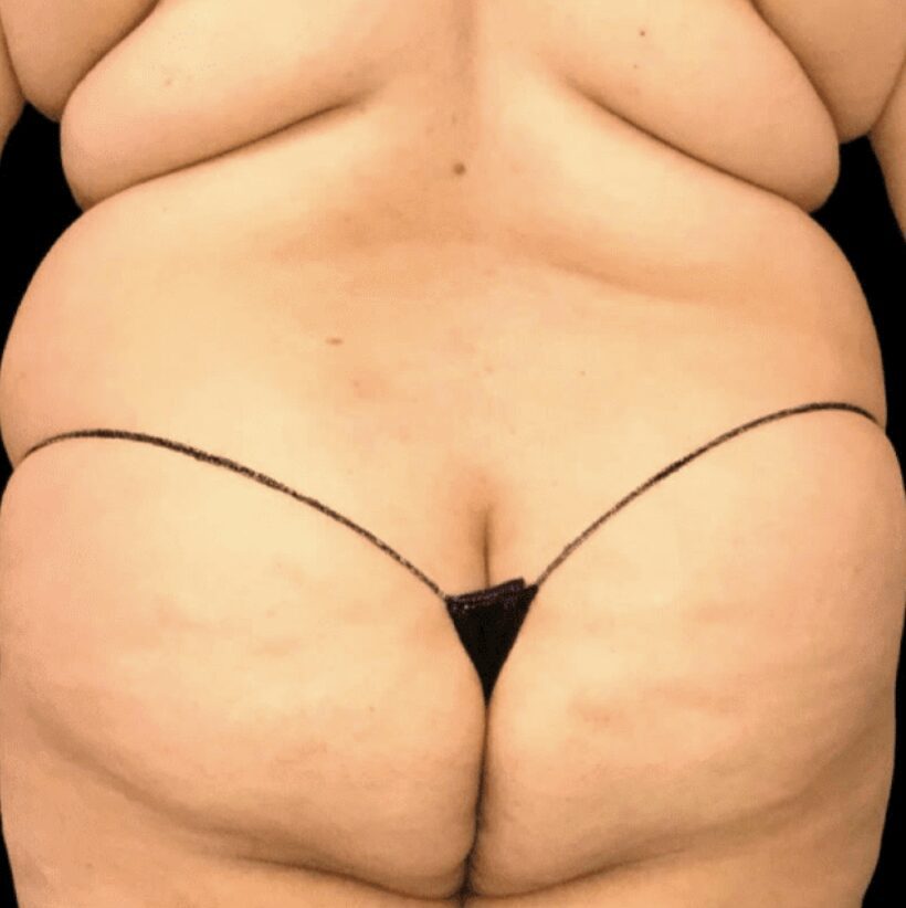 Before stomach liposuction