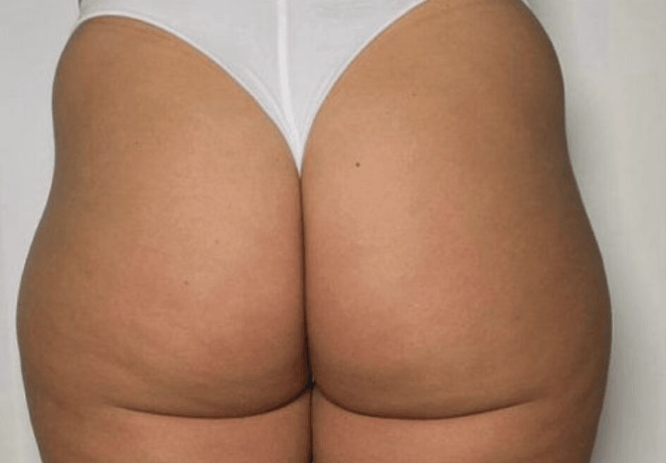 Before stomach and buttocks fat transfer