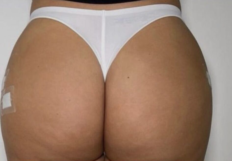 After stomach and buttocks fat transfer